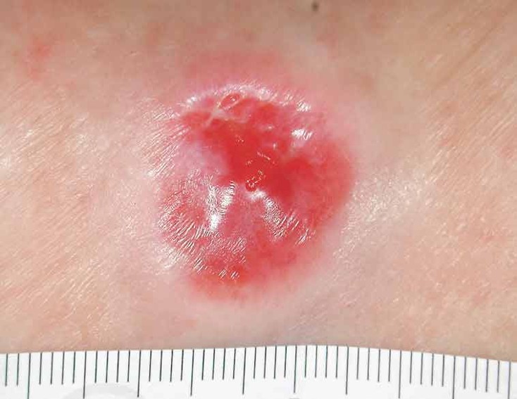 Plaie Epithelialisée1